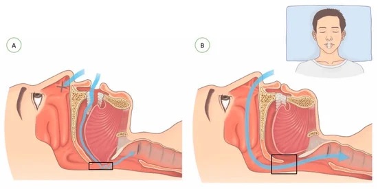 mouth-breathing-nose-breathing