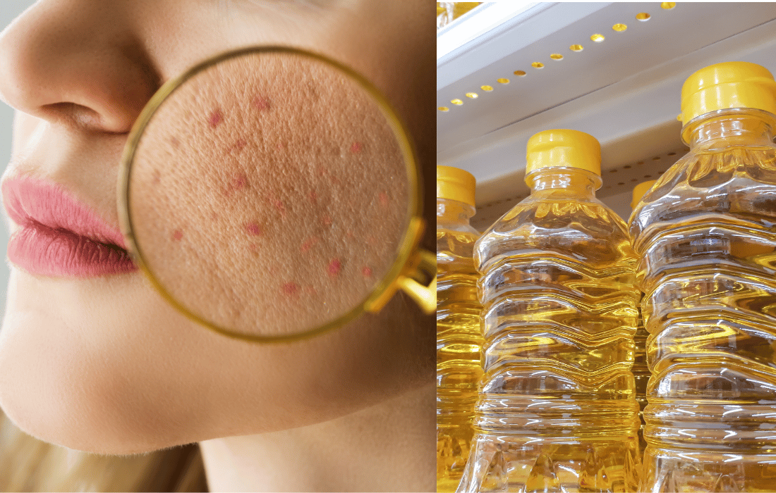 seed-oils-affect-skin-health-acne-eczema-aging