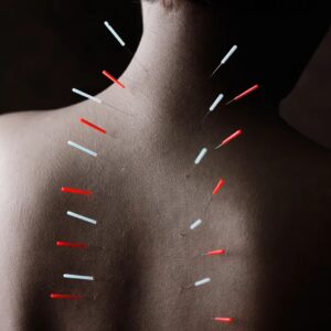 acupuncture