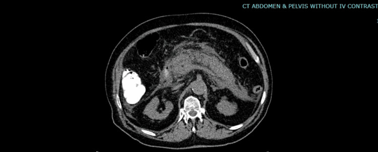 swollen-pancreas-ozempic