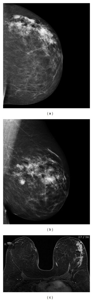 Multifocal-Breast-Cancer-Young-Women-Cell-Phone-Radiation - KyletotheMoon Health & Wellness Multifocal-Breast-Cancer-Young-Women-Cell-Phone-Radiation