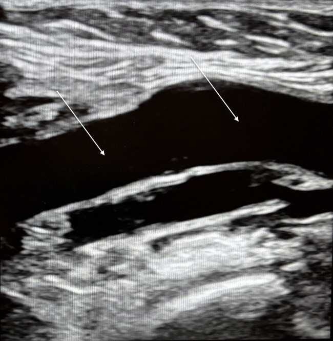 normal-popliteal-vein - KyletotheMoon Health & Wellness normal-popliteal-vein